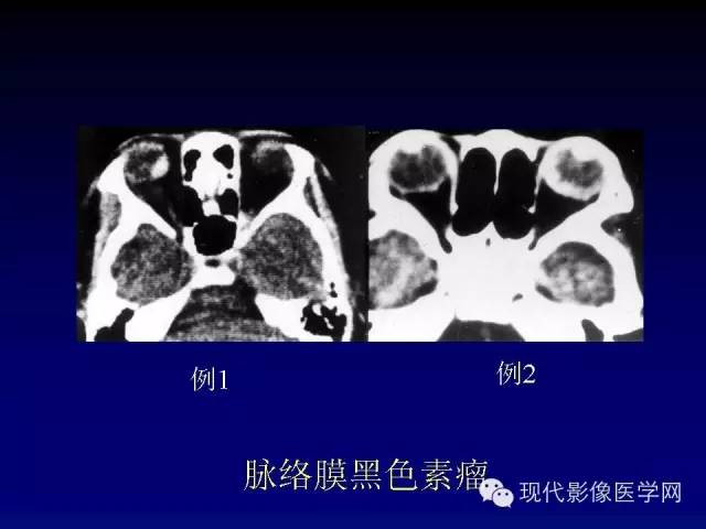 【PPT】眼眶肿瘤的CT MRI诊断