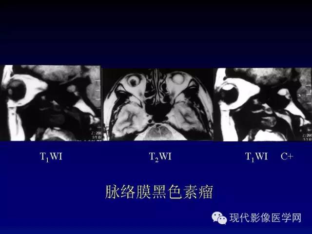 【PPT】眼眶肿瘤的CT MRI诊断