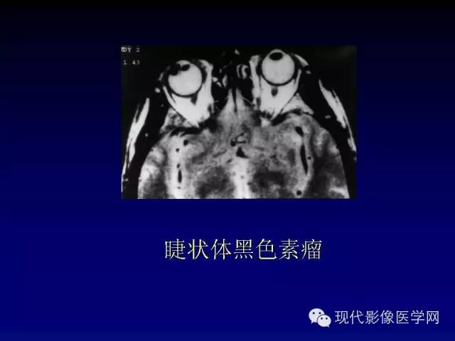 【PPT】眼眶肿瘤的CT MRI诊断