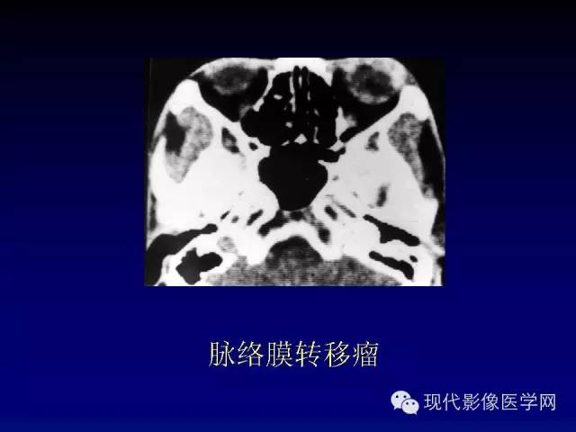 【PPT】眼眶肿瘤的CT MRI诊断