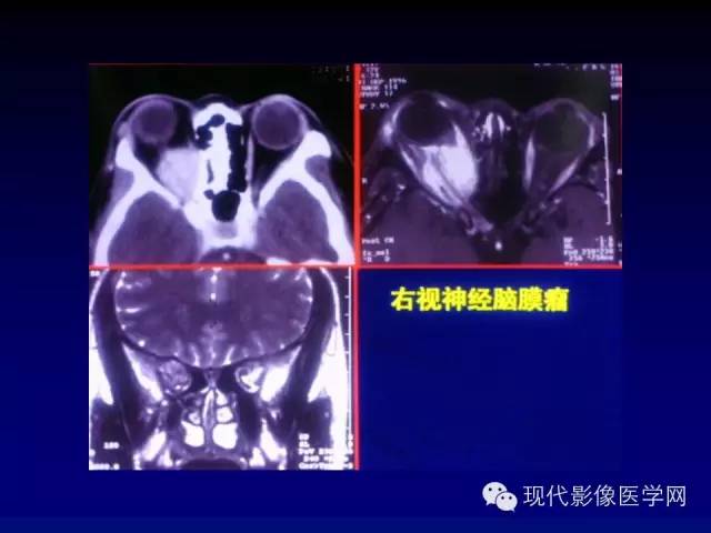 【PPT】眼眶肿瘤的CT MRI诊断