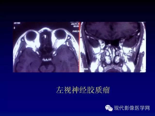 【PPT】眼眶肿瘤的CT MRI诊断