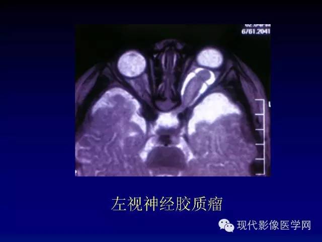 【PPT】眼眶肿瘤的CT MRI诊断