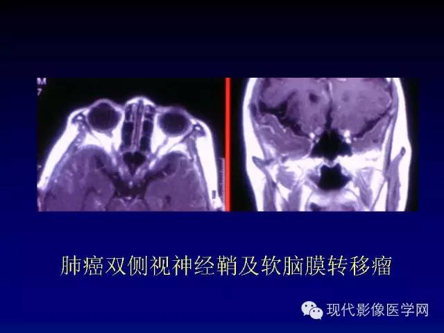 【PPT】眼眶肿瘤的CT MRI诊断