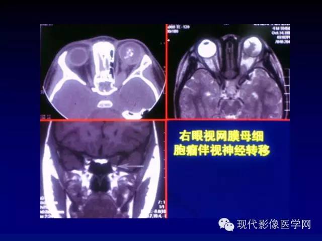 【PPT】眼眶肿瘤的CT MRI诊断