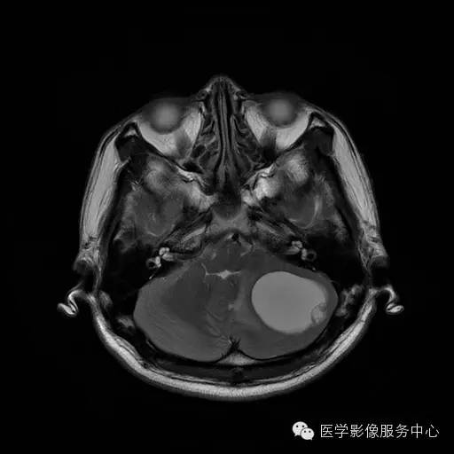 【病例】小脑血管母细胞瘤1例MR影像表现 【病例】小脑血管母细胞瘤1例MR影像表现