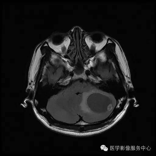 【病例】小脑血管母细胞瘤1例MR影像表现 【病例】小脑血管母细胞瘤1例MR影像表现