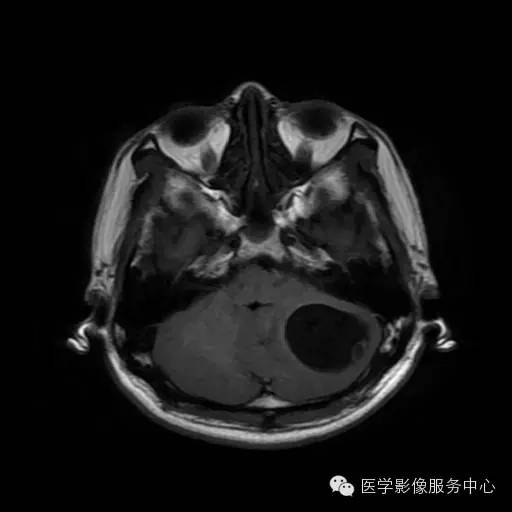【病例】小脑血管母细胞瘤1例MR影像表现 【病例】小脑血管母细胞瘤1例MR影像表现