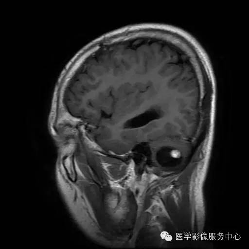 【病例】小脑血管母细胞瘤1例MR影像表现 【病例】小脑血管母细胞瘤1例MR影像表现