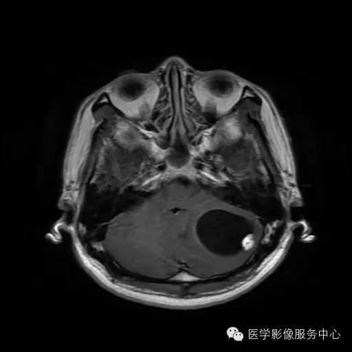 【病例】小脑血管母细胞瘤1例MR影像表现 【病例】小脑血管母细胞瘤1例MR影像表现