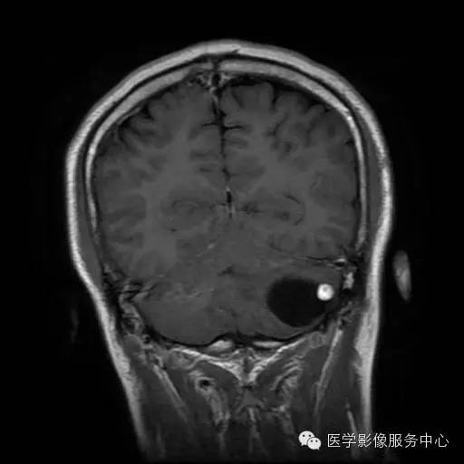 【病例】小脑血管母细胞瘤1例MR影像表现 【病例】小脑血管母细胞瘤1例MR影像表现