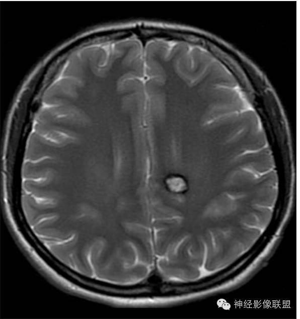 颅内T2WI低信号病变 颅内T2WI低信号病变