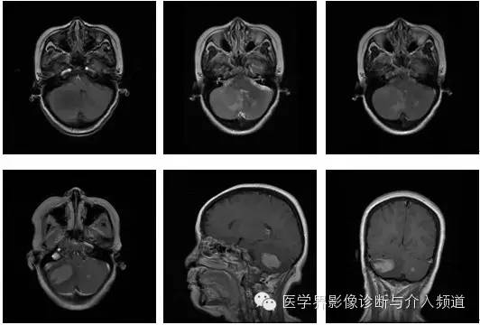 小脑肿瘤的MRI表现