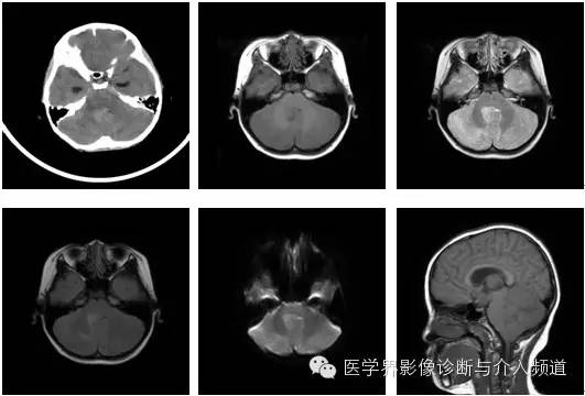 小脑肿瘤的MRI表现