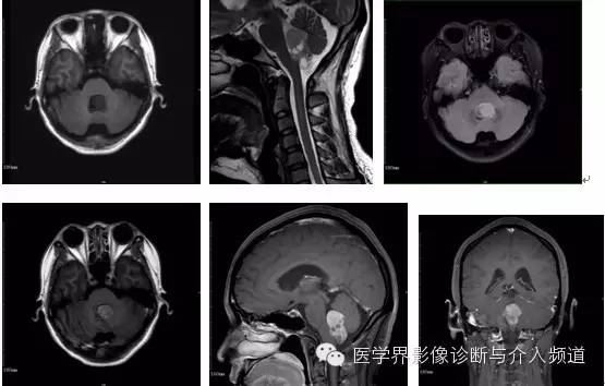 小脑肿瘤的MRI表现