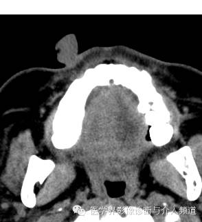 【病例】鼻翼基底细胞癌1例CT MR影像表现