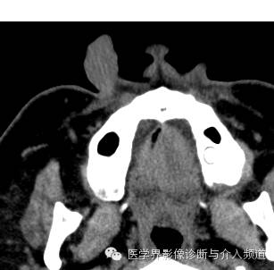 【病例】鼻翼基底细胞癌1例CT MR影像表现 【病例】鼻翼基底细胞癌1例CT MR影像表现