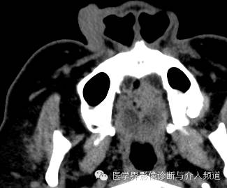 【病例】鼻翼基底细胞癌1例CT MR影像表现 【病例】鼻翼基底细胞癌1例CT MR影像表现