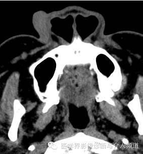 【病例】鼻翼基底细胞癌1例CT MR影像表现 【病例】鼻翼基底细胞癌1例CT MR影像表现