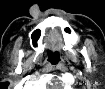 【病例】鼻翼基底细胞癌1例CT MR影像表现 【病例】鼻翼基底细胞癌1例CT MR影像表现