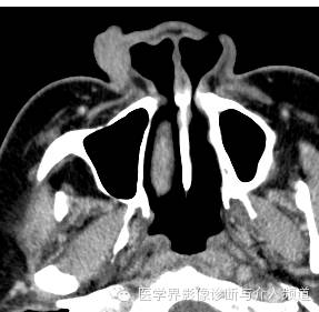 【病例】鼻翼基底细胞癌1例CT MR影像表现 【病例】鼻翼基底细胞癌1例CT MR影像表现
