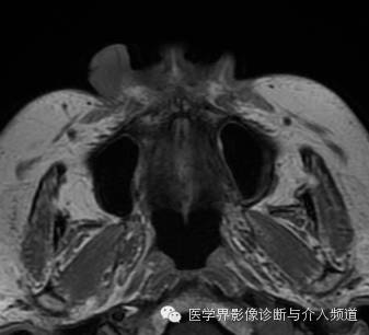 【病例】鼻翼基底细胞癌1例CT MR影像表现 【病例】鼻翼基底细胞癌1例CT MR影像表现