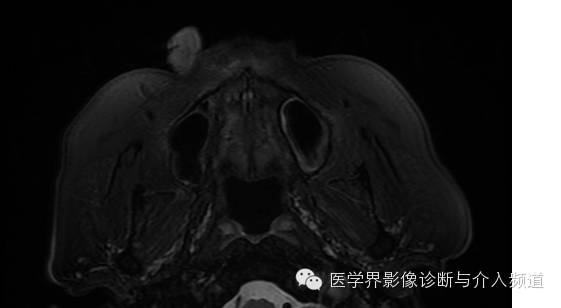 【病例】鼻翼基底细胞癌1例CT MR影像表现 【病例】鼻翼基底细胞癌1例CT MR影像表现