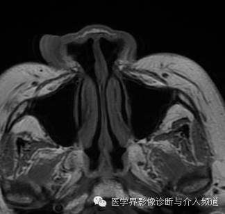 【病例】鼻翼基底细胞癌1例CT MR影像表现 【病例】鼻翼基底细胞癌1例CT MR影像表现