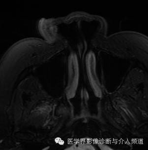 【病例】鼻翼基底细胞癌1例CT MR影像表现 【病例】鼻翼基底细胞癌1例CT MR影像表现