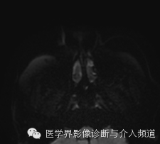 【病例】鼻翼基底细胞癌1例CT MR影像表现 【病例】鼻翼基底细胞癌1例CT MR影像表现
