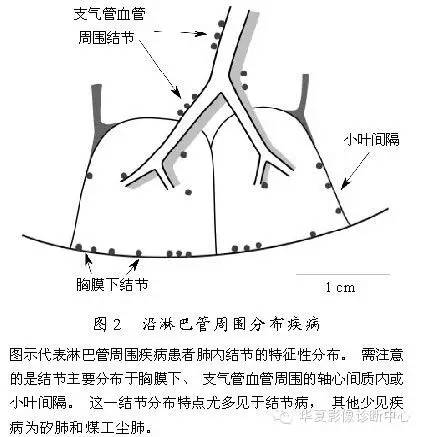 肺内多发结节的高分辨率CT鉴别诊断流程 肺内多发结节的高分辨率CT鉴别诊断流程