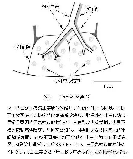 肺内多发结节的高分辨率CT鉴别诊断流程 肺内多发结节的高分辨率CT鉴别诊断流程