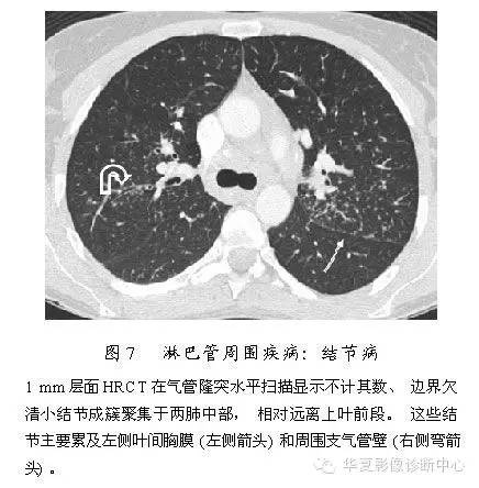 肺内多发结节的高分辨率CT鉴别诊断流程 肺内多发结节的高分辨率CT鉴别诊断流程