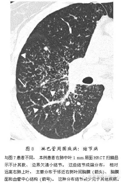 肺内多发结节的高分辨率CT鉴别诊断流程 肺内多发结节的高分辨率CT鉴别诊断流程