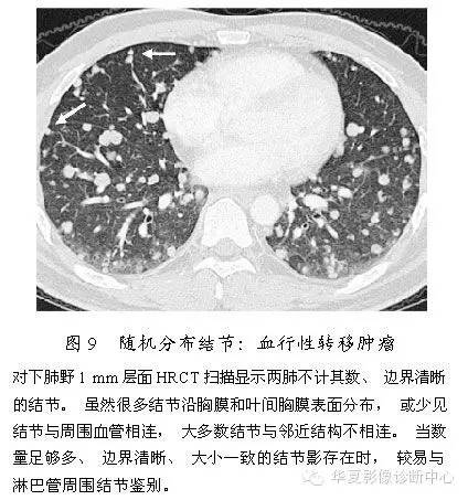 肺内多发结节的高分辨率CT鉴别诊断流程 肺内多发结节的高分辨率CT鉴别诊断流程