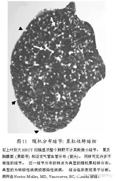 肺内多发结节的高分辨率CT鉴别诊断流程 肺内多发结节的高分辨率CT鉴别诊断流程