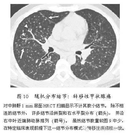 肺内多发结节的高分辨率CT鉴别诊断流程 肺内多发结节的高分辨率CT鉴别诊断流程