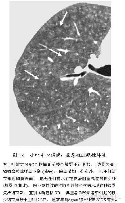 肺内多发结节的高分辨率CT鉴别诊断流程 肺内多发结节的高分辨率CT鉴别诊断流程
