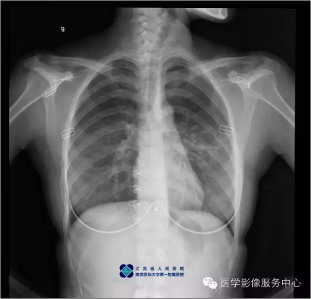 【病例】左下肺先天性肺囊肿1例X线CT影像表现