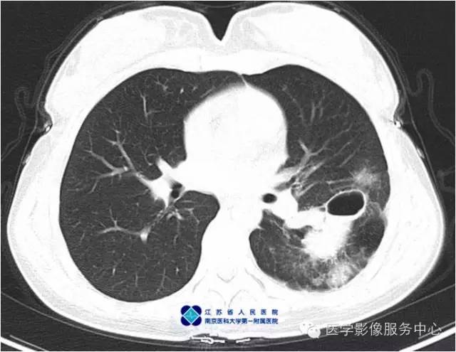 【病例】左下肺先天性肺囊肿1例X线CT影像表现