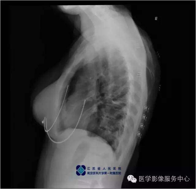 【病例】左下肺先天性肺囊肿1例X线CT影像表现