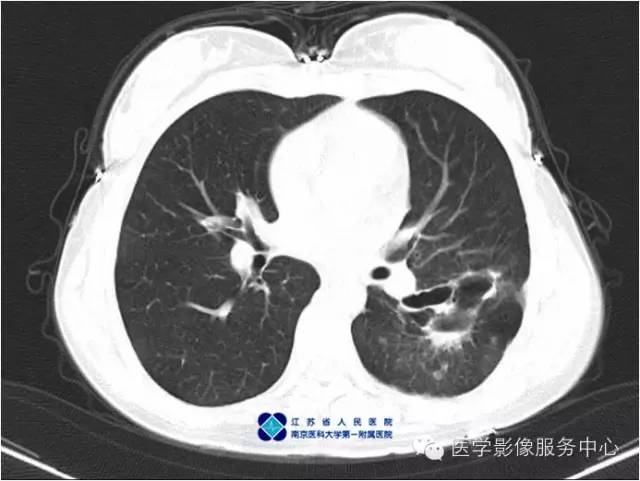 【病例】左下肺先天性肺囊肿1例X线CT影像表现
