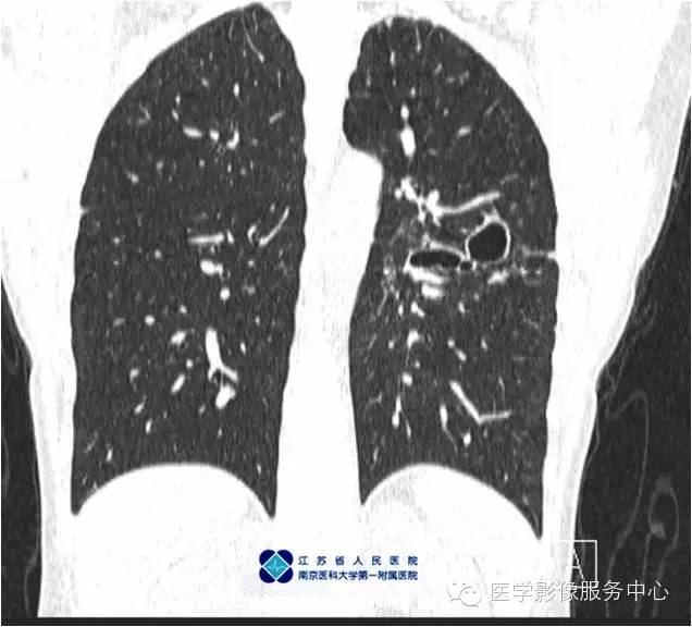 【病例】左下肺先天性肺囊肿1例X线CT影像表现
