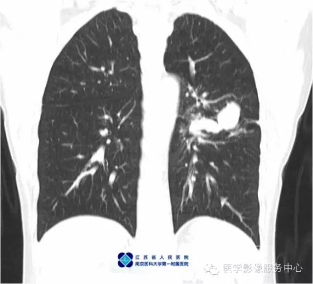 【病例】左下肺先天性肺囊肿1例X线CT影像表现