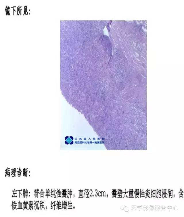 【病例】左下肺先天性肺囊肿1例X线CT影像表现