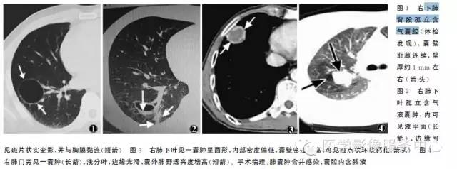 【病例】左下肺先天性肺囊肿1例X线CT影像表现