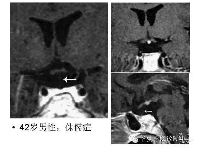 【PPT】垂体柄中断综合征