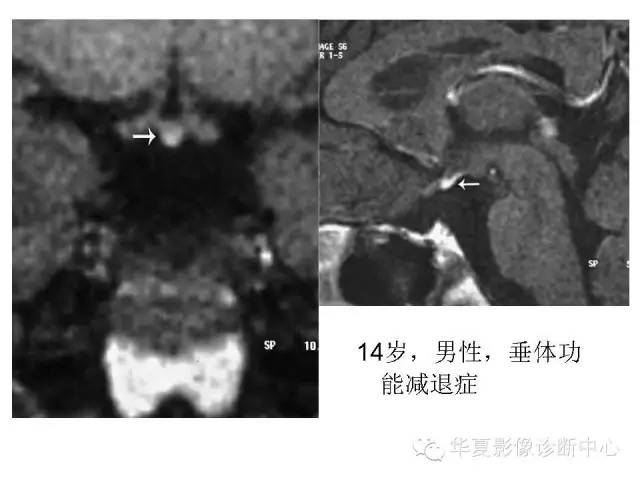 【PPT】垂体柄中断综合征