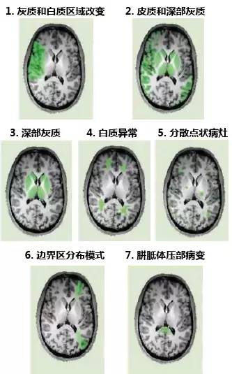 脑卒中影像学鉴别诊断
