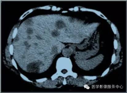 【病例】肝脏上皮样血管内皮瘤1例CT影像表现与鉴别